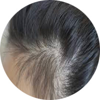 女性によくある薄毛パターン　牽引性脱毛症