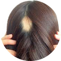 女性によくある薄毛パターン　細菌（円形・多発）脱毛症